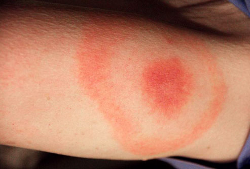 Bệnh Lyme